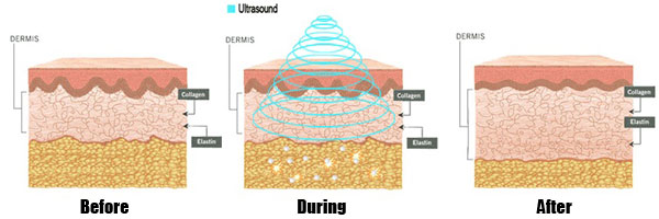 Ultrasound Cavitation Body Contouring Treatment