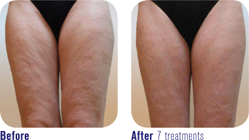 RF Radio Frequency Skin Body Tightening