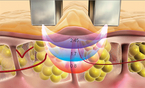 RF Radio Frequency Skin Body Tightening